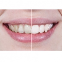 Вредните навици, които са причина зъбите да пожълтяват